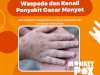 Waspada dan Kenali Penyakit Cacar Monyet/ Monkeypox